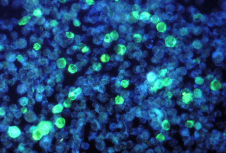 Electron micrograph of leukemia cells