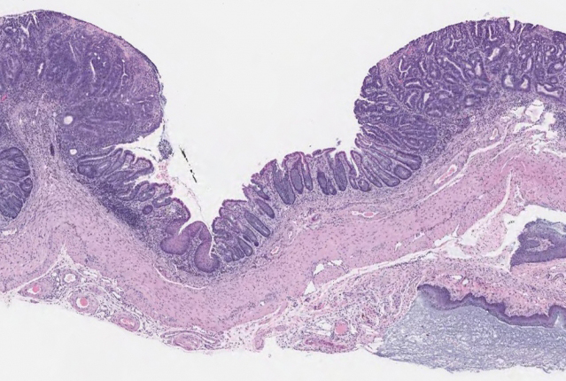 engrafted tumor