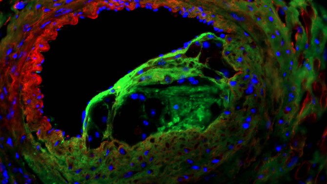 Left anterior descending coronary artery with atherosclerotic lesion immunofluorescently stained for alpha-smooth muscle cell (green), collagen-I (red) and nuclei (blue) in an animal model.