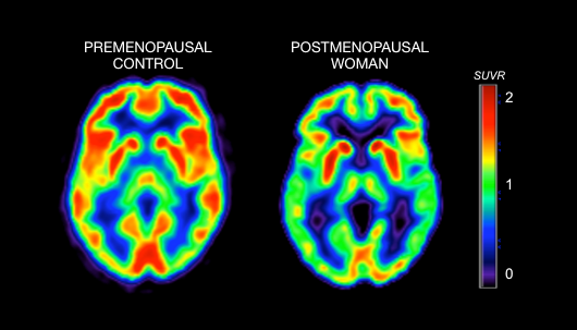 shows brain activity in a premenopausal woman; the scan to the right shows brain activity in a postmenopausal woman