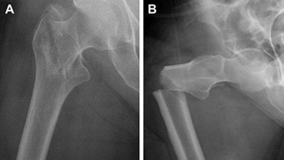 Mechanisms found to explain atypical femoral fractures | Cornell Chronicle