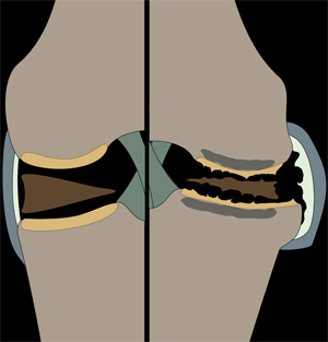 illustration of an osteoarthritic joint