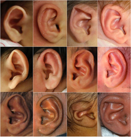 before and after photos of infant ears