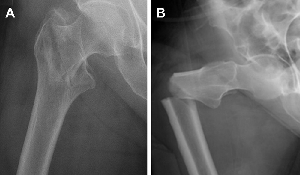 Radiograph imaging of a fragility fracture of the hip