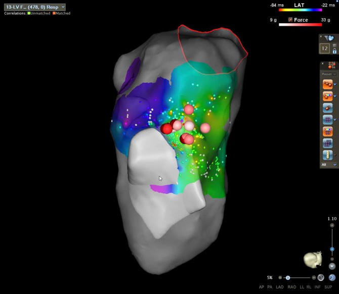 This 3D electro-anatomical map of Nittany’s heart shows where ablation was needed.