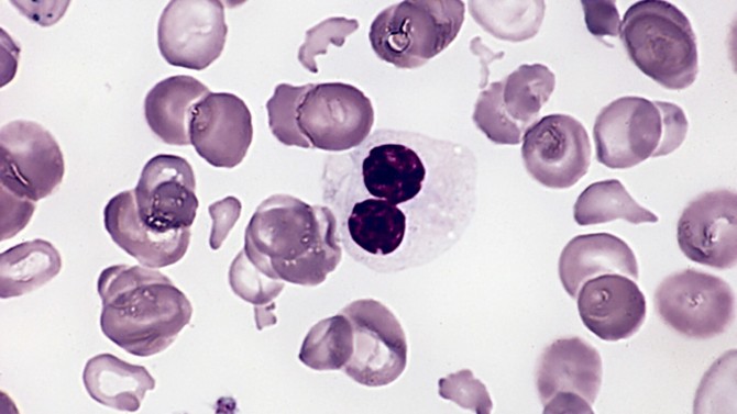 Blood smear from an adult female with myelodysplastic syndrome