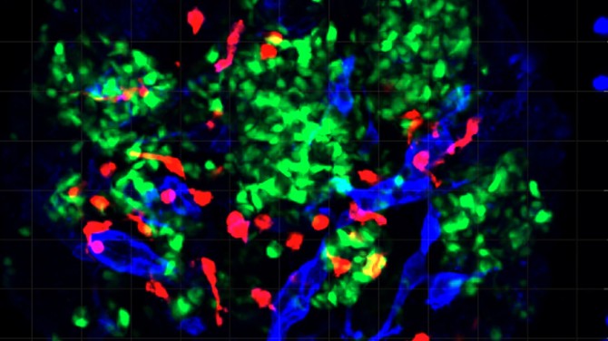 A mini-organ made from human stem cells that includes insulin-producing pancreatic cells (green), blood vessel cells (blue), and immune cells (red).