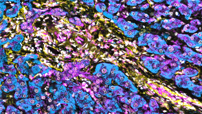 Low NBR1 levels in hepatic stellate cells enhance interferon signaling in human hepatocellular carcinoma. Hepatic stellate cells are labeled in yellow and show reduced NBR1 expression (turquoise), whereas the strong immune response is indicated by STING staining (magenta).