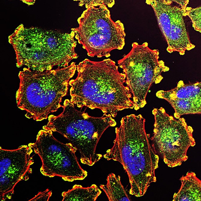 Researchers have discovered how some skin cancer cells defend against oxidative stress and metastasize to new organs. The anatomy of metastatic melanoma cells pictured above: podosomes (yellow), nuclei (blue), actin (red), and an actin regulator (green).