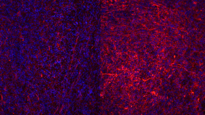 Microscope images of the extracellular matrix and cells, cells are stained in blue and collagen in red. Regressing tumors on the left are surround by less dense collagen compared to resistant ones (right) with dense collagen