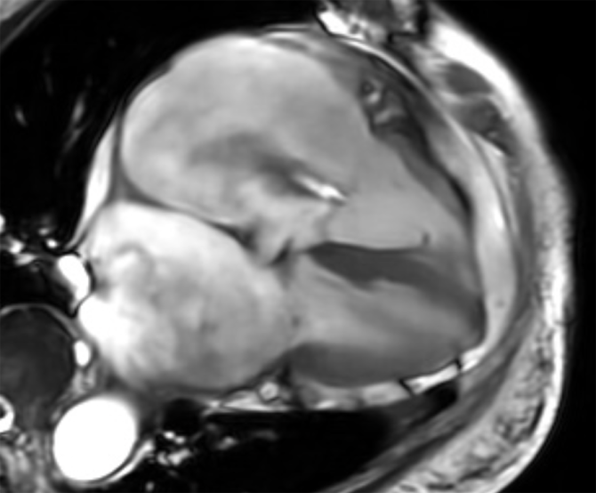 Representative cine-CMR four-chamber image demonstrating severe tricuspid regurgitation.
