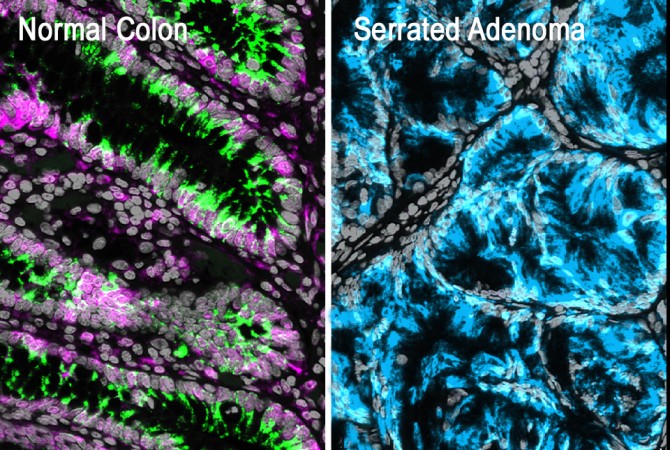 Multiplex immunofluorescence image showing a healthy colon lining and a premalignant serrated lesion