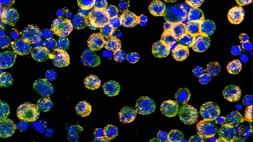 Discovery reveals how ovarian cancer disables immune cells