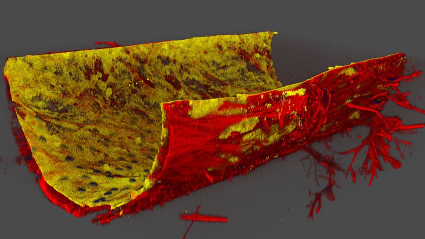 Immunofluorescence staining shows the layers of trabecular meshwork (red) and Schlemm’s canal endothelium (yellow) cells in a 3D “eye-on-a-chip” platform that mimics the flow of ocular fluids.