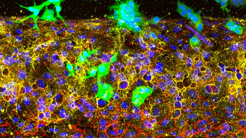A 3D tumor vessel-on-a-chip model