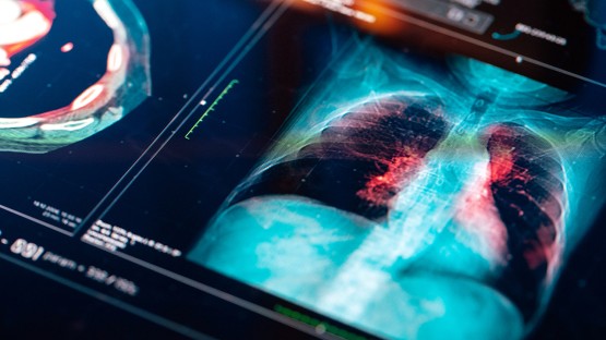 Genetic signature may predict lung cancer response to immunotherapy - Vimarsana News