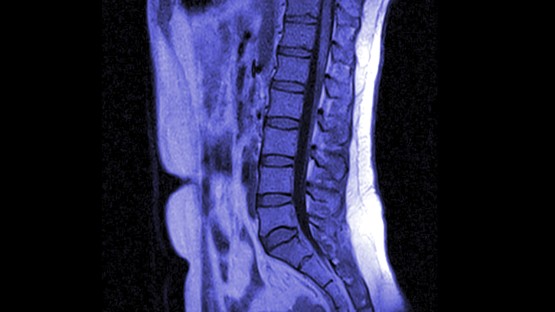Study reveals why cancer may spread to the spine - Vimarsana News