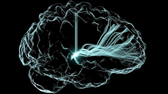 Deep brain stimulation improves cognition after injury - Vimarsana News