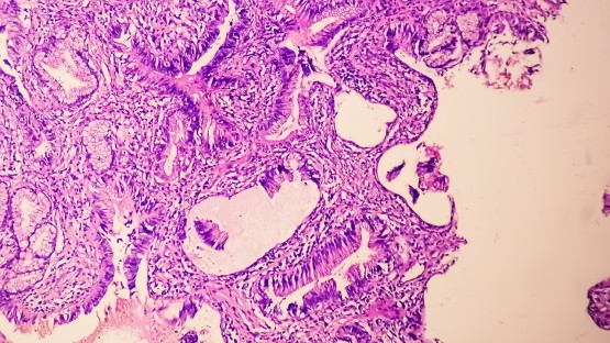 Image of the PSA levels alone may not reflect prostate cancer growth - Cornell Chronicle news article