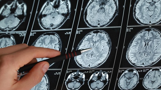 Grant to help develop portable PET scanner for Alzheimer’s | Cornell ...