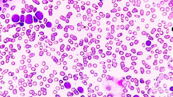Oral drug combination eases treatment burden for AML patients