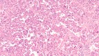 ovarian cancer cells