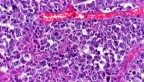 Diffuse large B-cell lymphoma